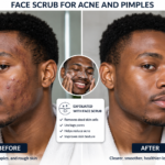 African man with acne and pimples before and after exfoliating his face with a facial scrub for smoother-looking skin.